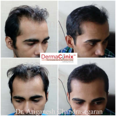 Best Hair Transplant in Chennai