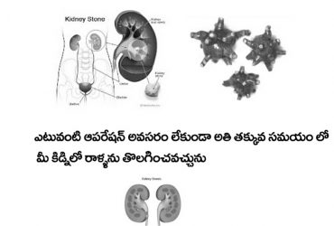 100 percnt cure for kidney stones without any operation .just with herbs ur prblm will b solved