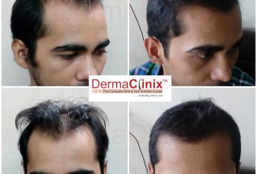 Hair Transplant Surgery in Chennai