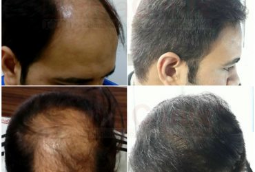 Hair Transplantation At 0% Risk Free at Best Hair Transplant Clinic in Chennai