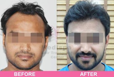 Best Hair Transplant Clinics in Delhi