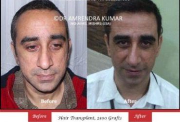 Hair Transplant Center in Delhi