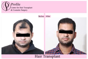 Best Centre For Hair Transplant Surgery in Punjab