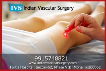 Laser Varicose veins Treatment | Varicose veins Specialists India – Indian Vascular Surgery