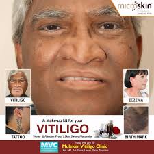 Best Vitiligo Treatment in India | Vitiligo Makeup Cream.