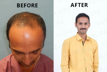 HairSure: Best Hair Transplant Clinic in Hyderabad