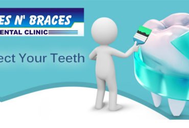 Braces in Lucknow | Dentist in Aliganj | Orthodontist in Lucknow