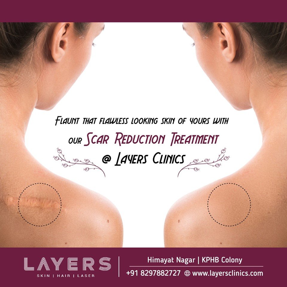 Best Comprehensive & Painless Scar Reduction Treatment in Hyderabad