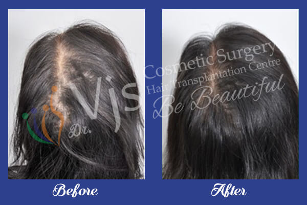 Hair Transplant in Andhra Pradesh – vjclinics
