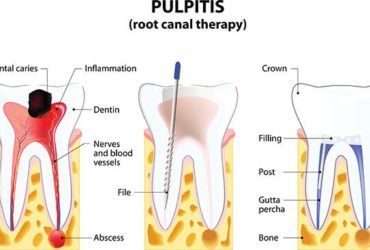 Best Root Canal Treatment in Gurgaon