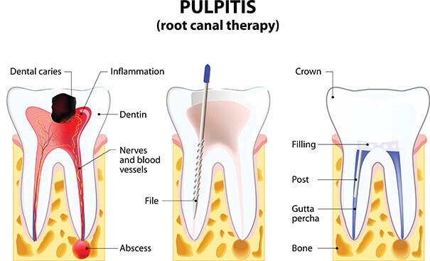 Best Root Canal Treatment in Gurgaon