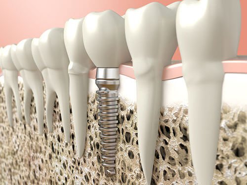 Best Dental Implant Clinic in Gurgaon