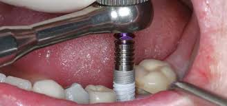Get Dental Implant Courses in India at affordable prices and With Experienced Trainers