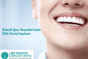 Implants in Upper Jaw | LBR Dental Implants