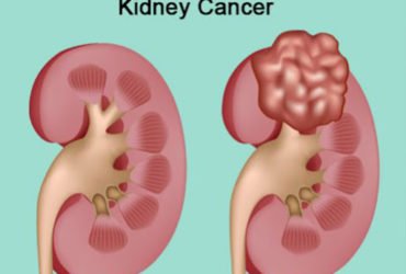 Dr. Vimal Dassi – Kidney Cancer Treatment in Delhi