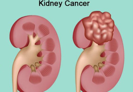 Dr. Vimal Dassi – Kidney Cancer Treatment in Delhi