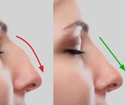 Rhinoplasty in Bangalore | Non Surgical Rhinoplasty Cost in Bangalore (Nose Job) – Anew