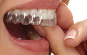 Teeth Straightening Aligners, Clear Teeth Straighteners