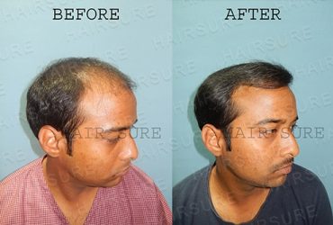 Best Hair Transplant clinic in Hyderabad |  Hitech City