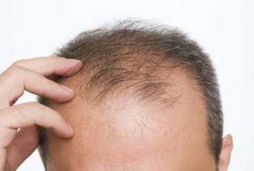 Quality Hair Transplant in Ludhiana by Experienced surgeon