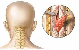 Spine Tumor Treatment in India