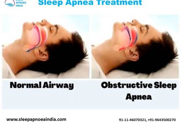 Sleep Apnea Treatment