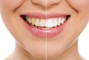 Get the Best Teeth Whitening Treatment in Hyderabad