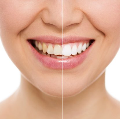 Get the Best Teeth Whitening Treatment in Hyderabad