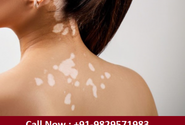 Best Homeopathy Treatment for Vitiligo in DLF Phase 4 | 9829571983