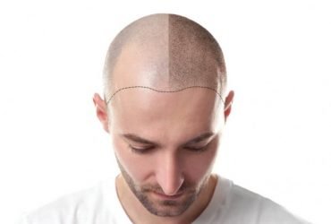 Hair Transplant in Delhi – Dr. Lokesh Handa
