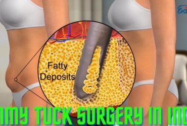 Tummy Tuck Surgery in India | EdhaCare