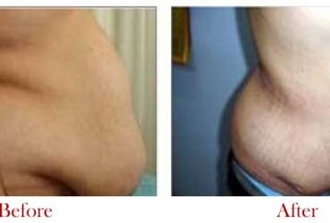 Tummy Tuck Surgery in Delhi – Dr Vivek Kumar