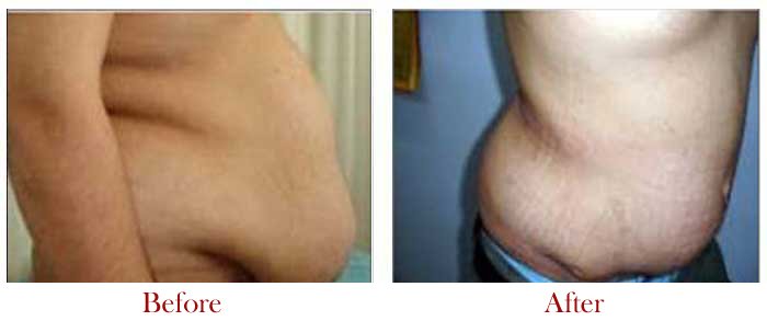 Tummy Tuck Surgery in Delhi – Dr Vivek Kumar