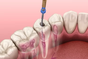 Root Canal Prices: Cost Breakdown & Key Factors