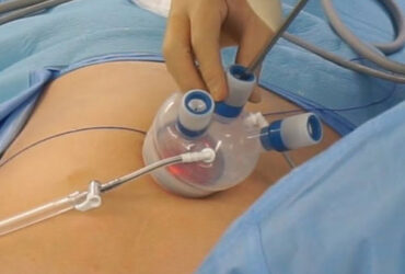 Single Port Laparoscopic Surgery in Mumbai